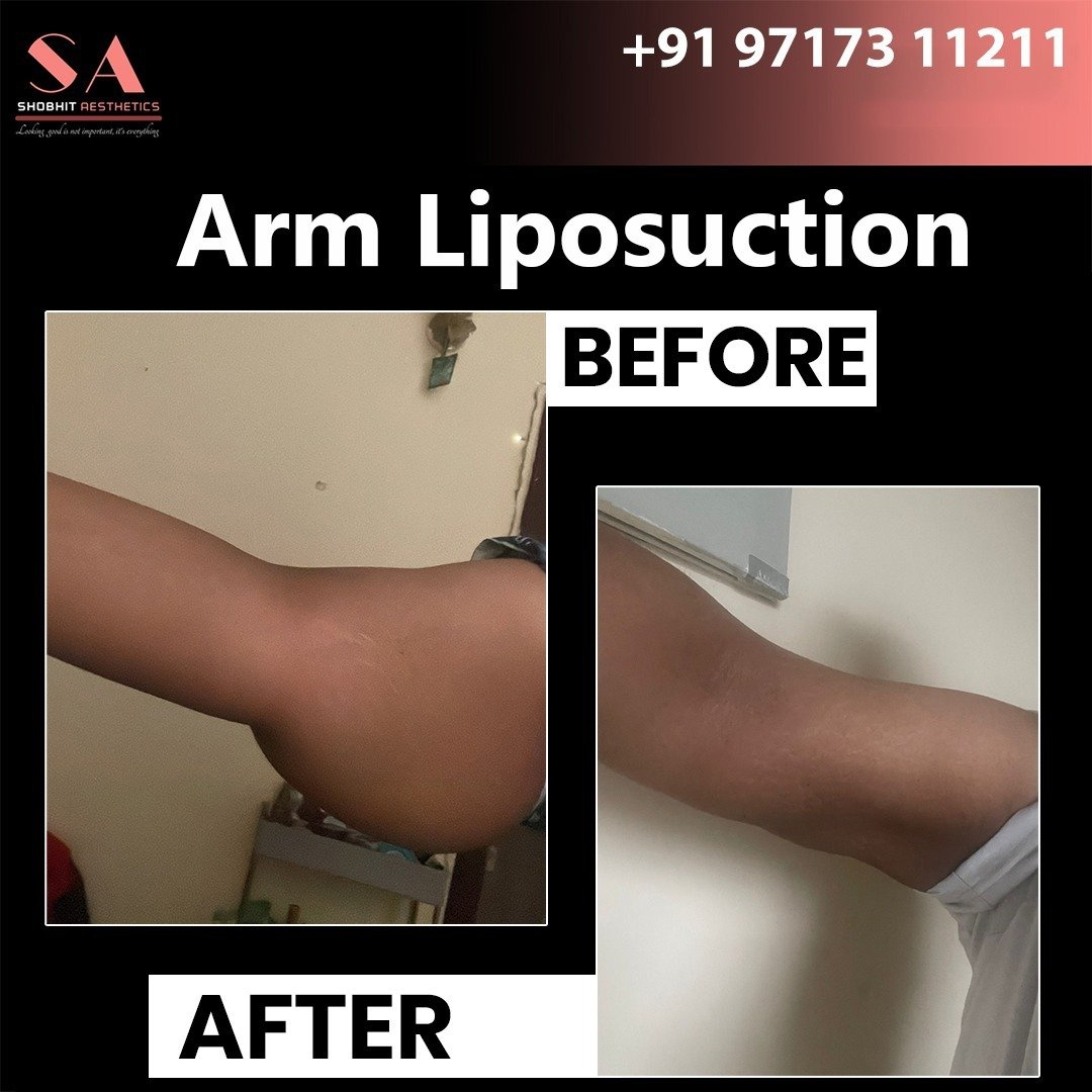 Liposuction in Noida