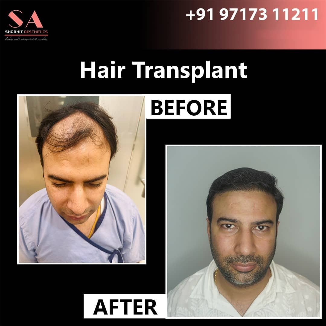 Hair Transplant in Pune