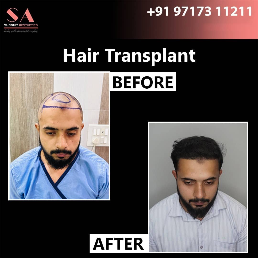 Hair Transplant in Pune