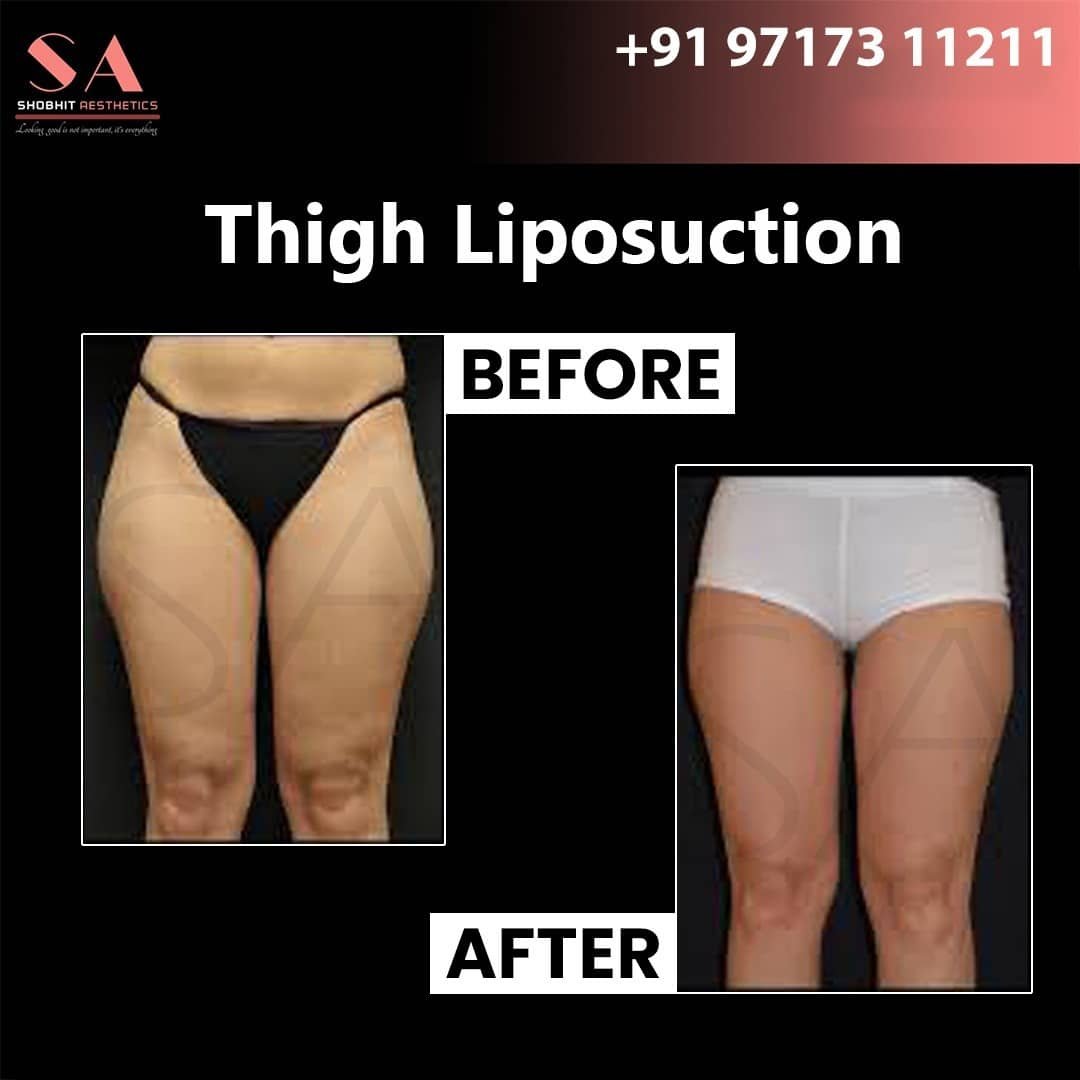 Liposuction in Noida
