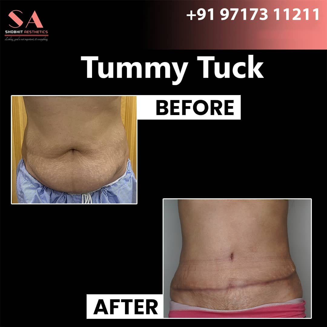 Tummy Tuck in Jaipur