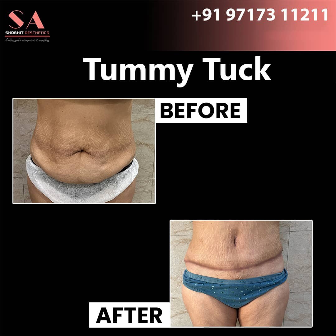 Tummy Tuck in Jaipur