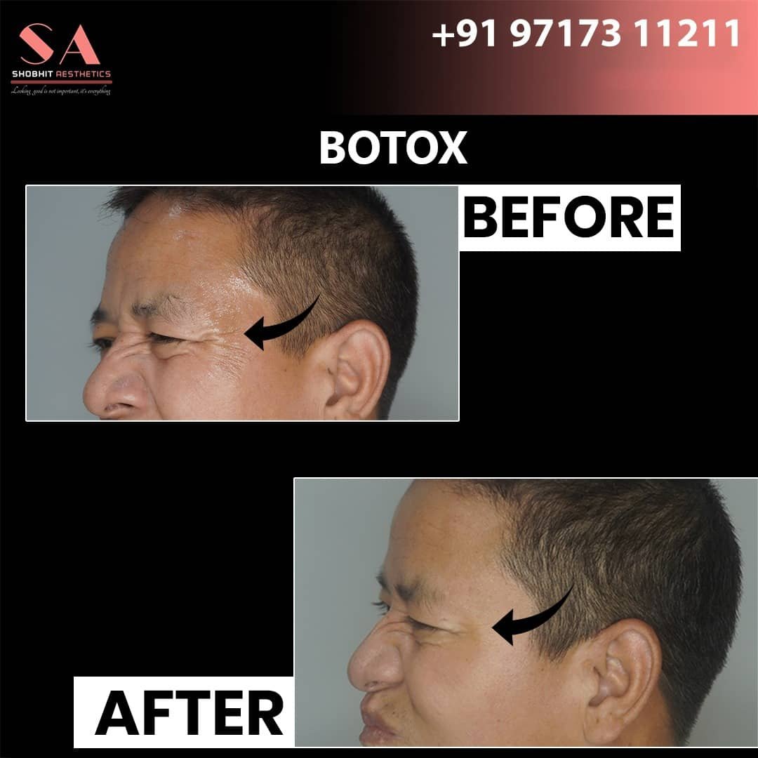 Botox & Fillers