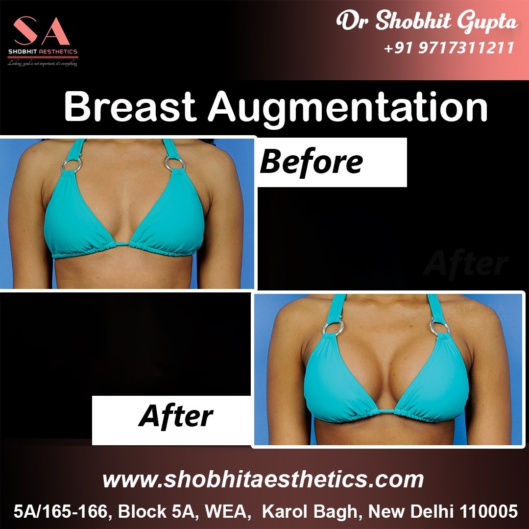 Breast Implant in Gurgaon
