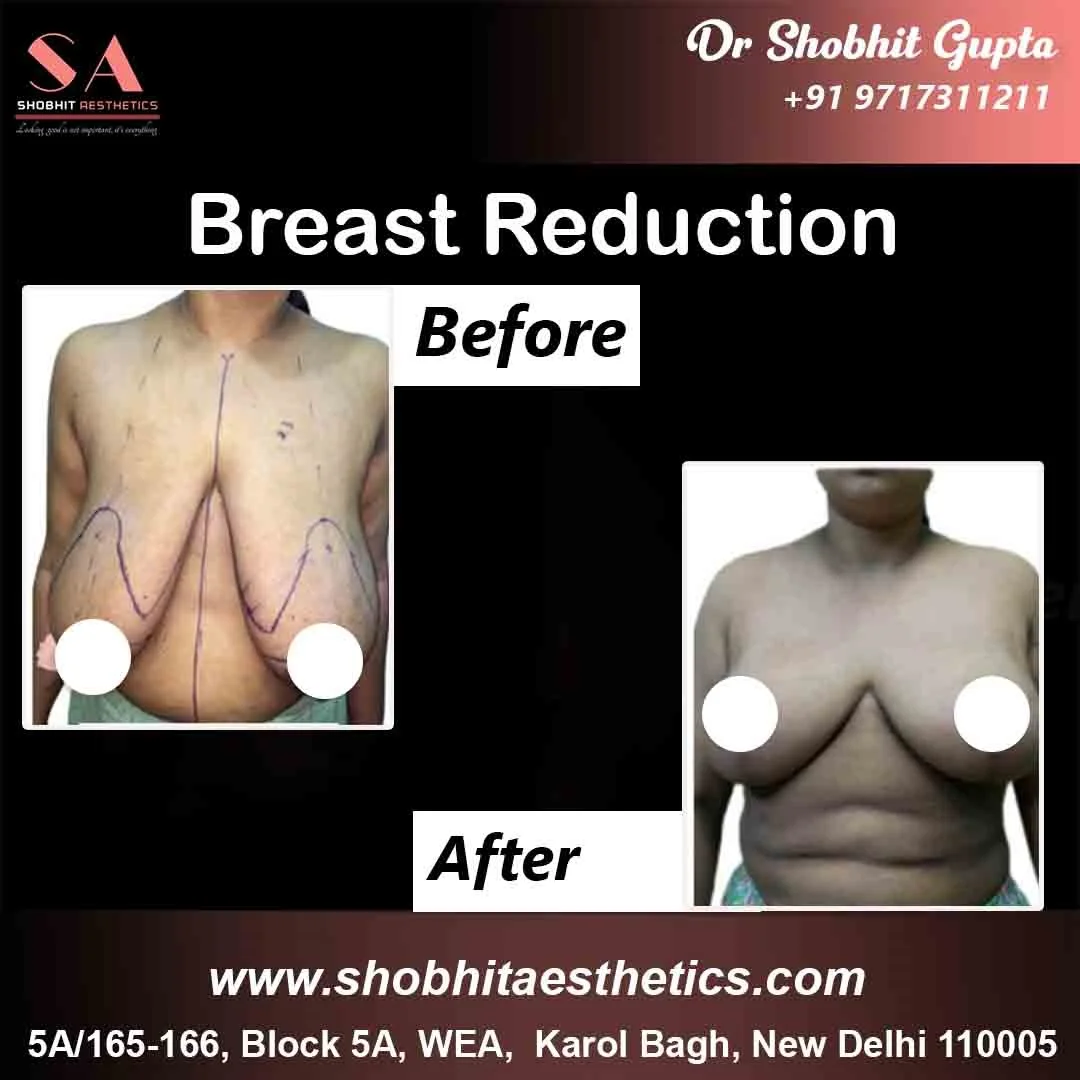 Breast Reduction Surgery in Ahmedabad India ADORN