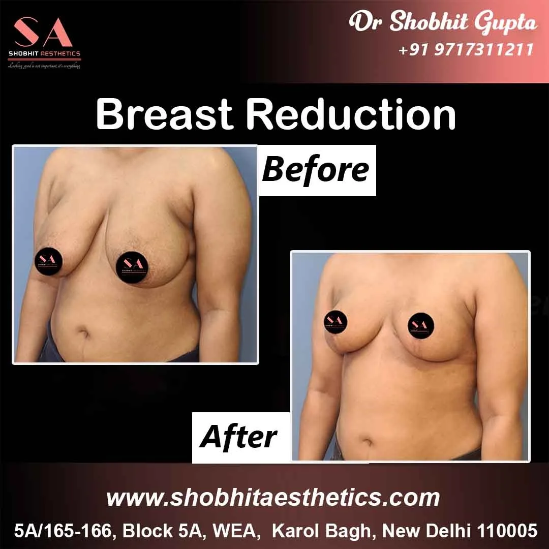 Best Female Breast Reduction Surgery Cost in Delhi India