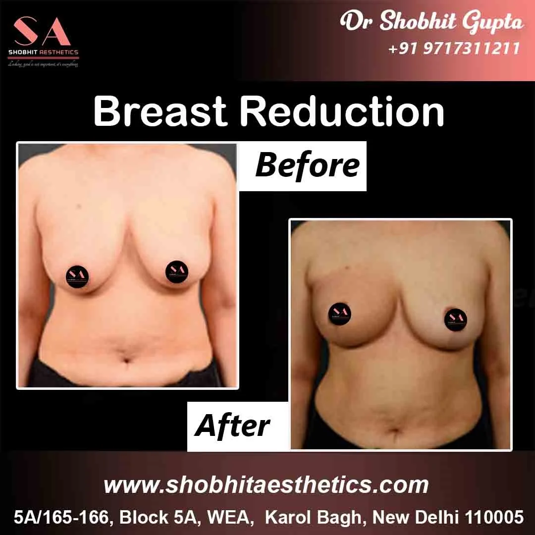 Best Female Breast Reduction Surgery Cost in Delhi India