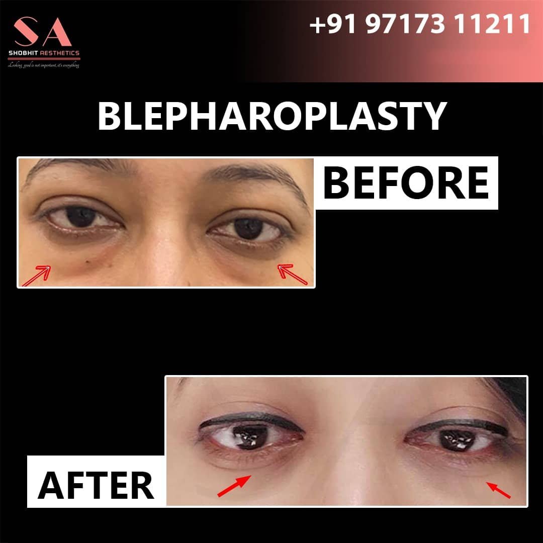 Eyelid_surgery_before_After_7.jpeg