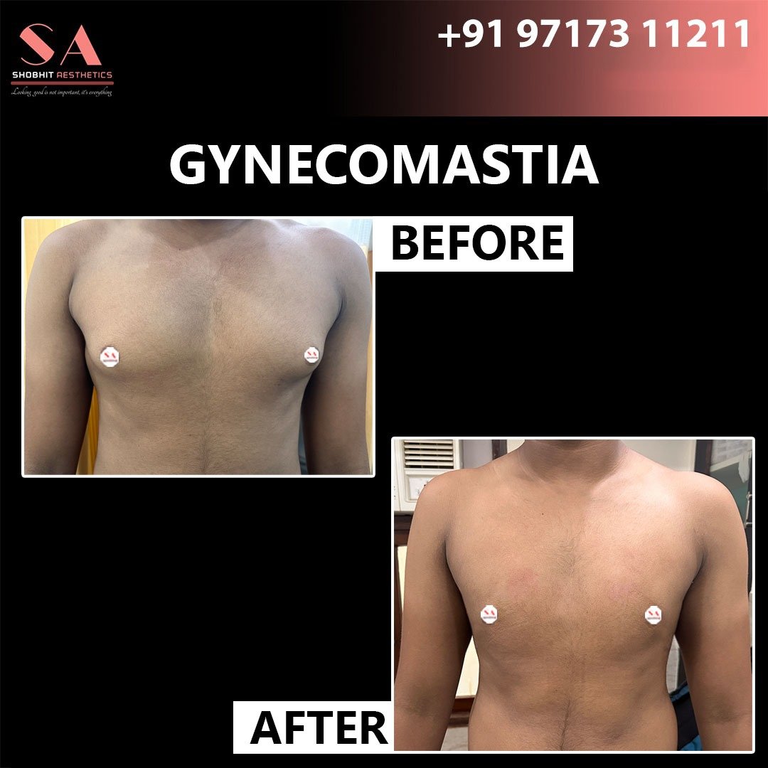 Gynecomastia Surgery in Gurgaon