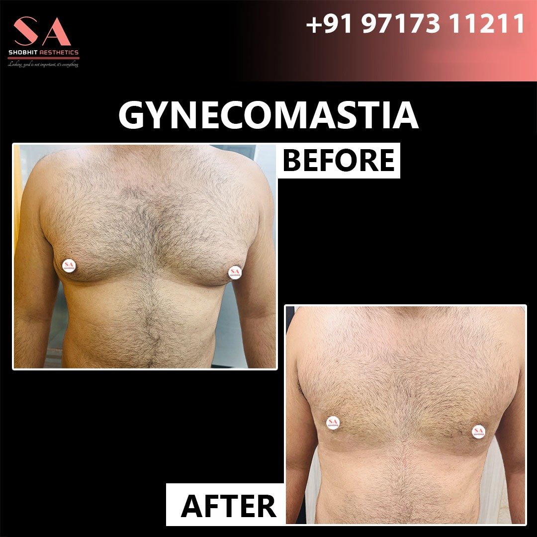 Gynecomastia Surgery in Gurgaon