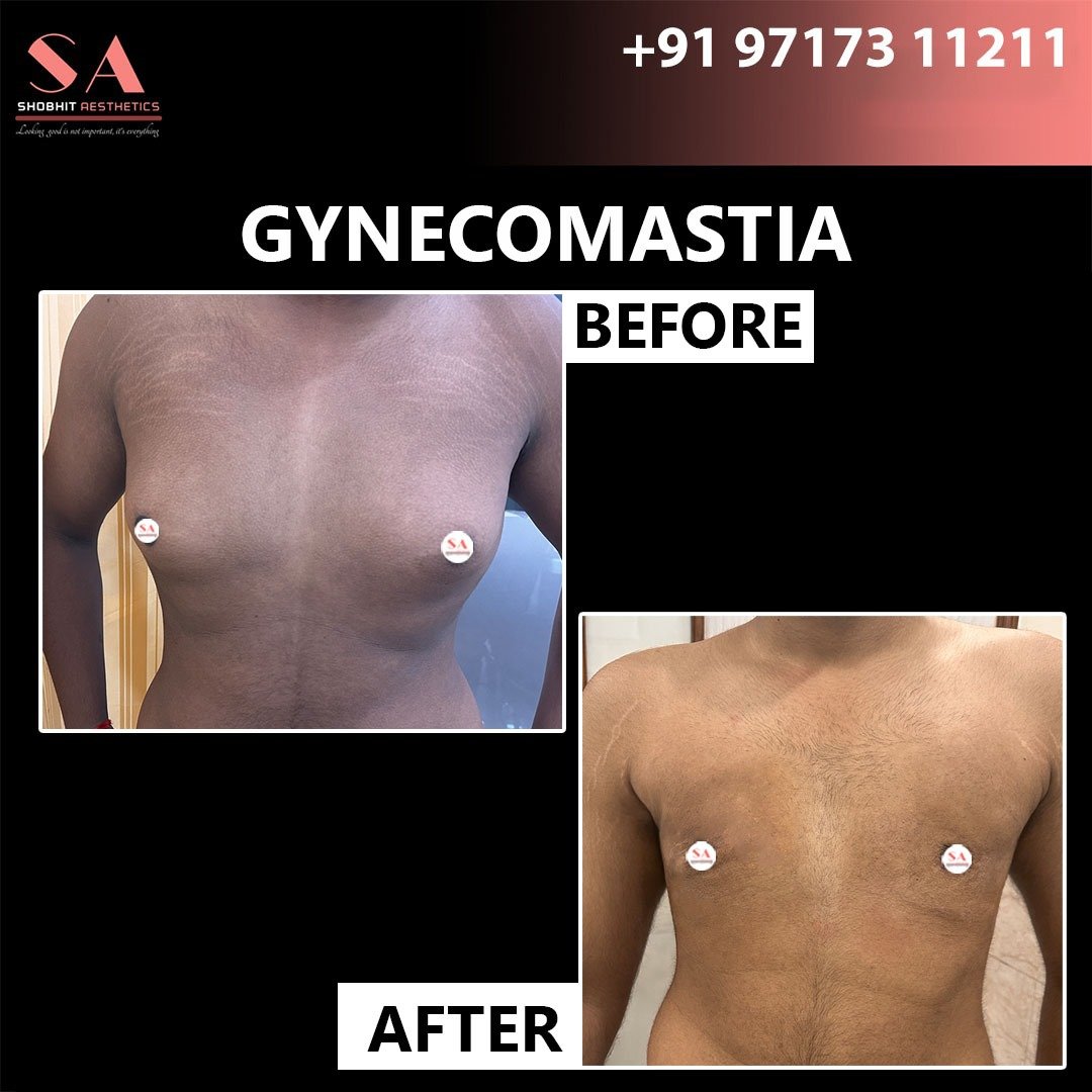 Gynecomastia in Kanpur