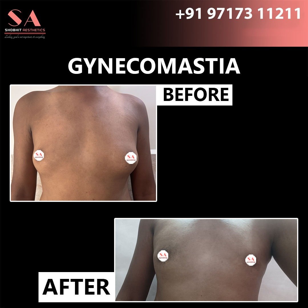 Gynecomastia Surgery in Ghaziabad