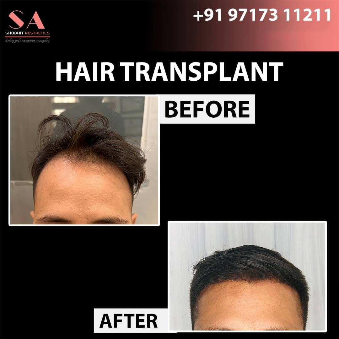 Hair Transplant In Ghaziabad