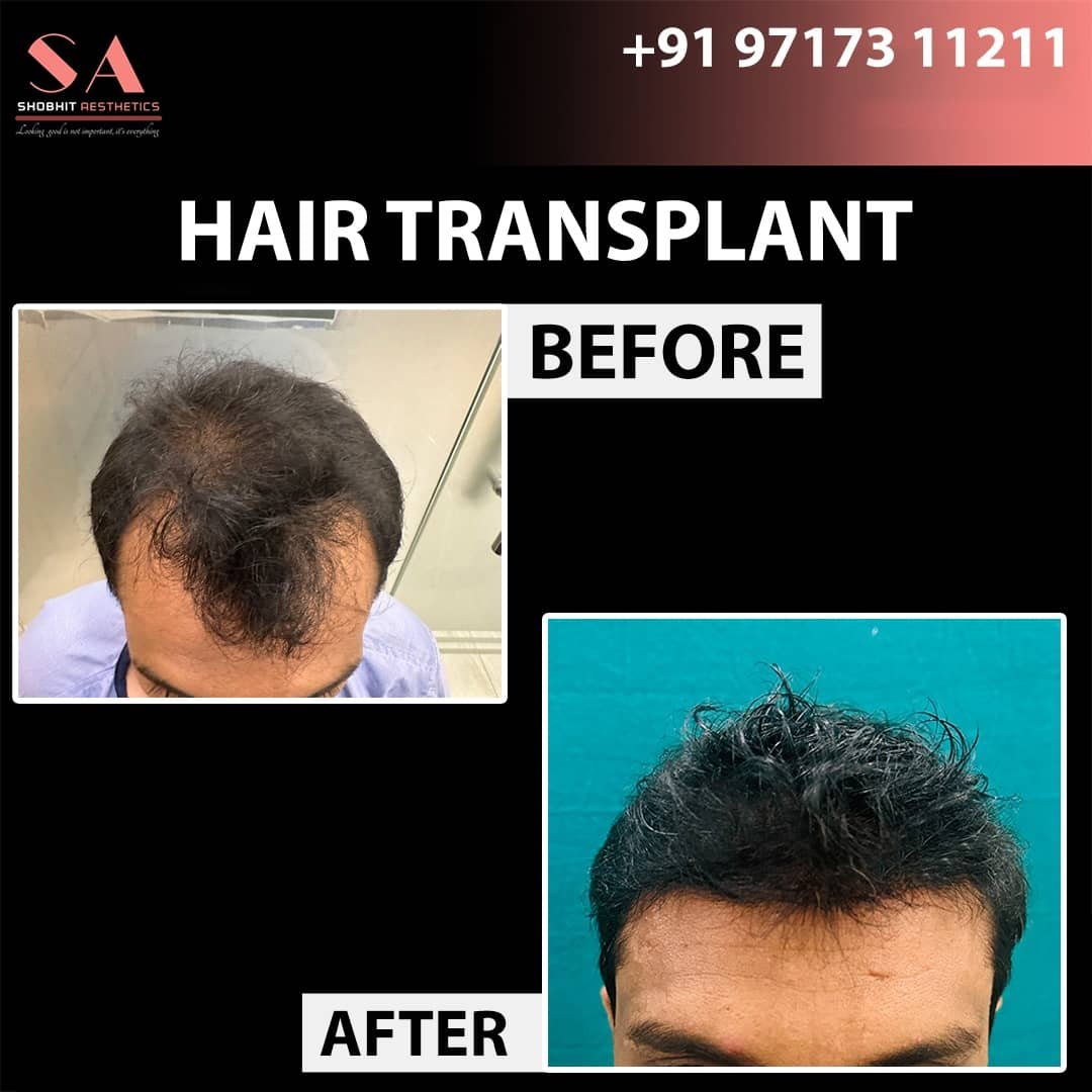 Hair Transplant In Noida