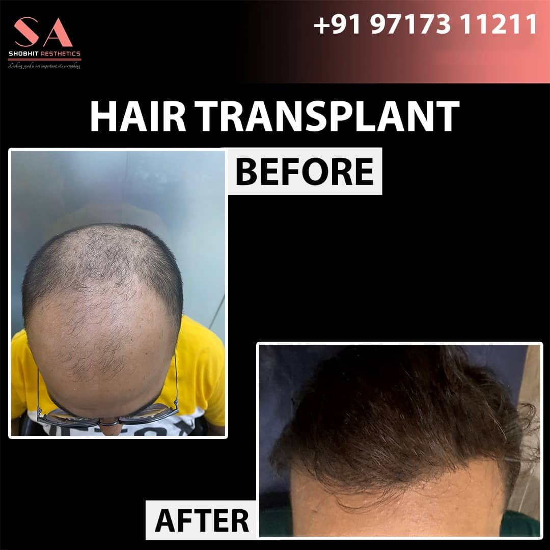 Hair Transplant In Noida