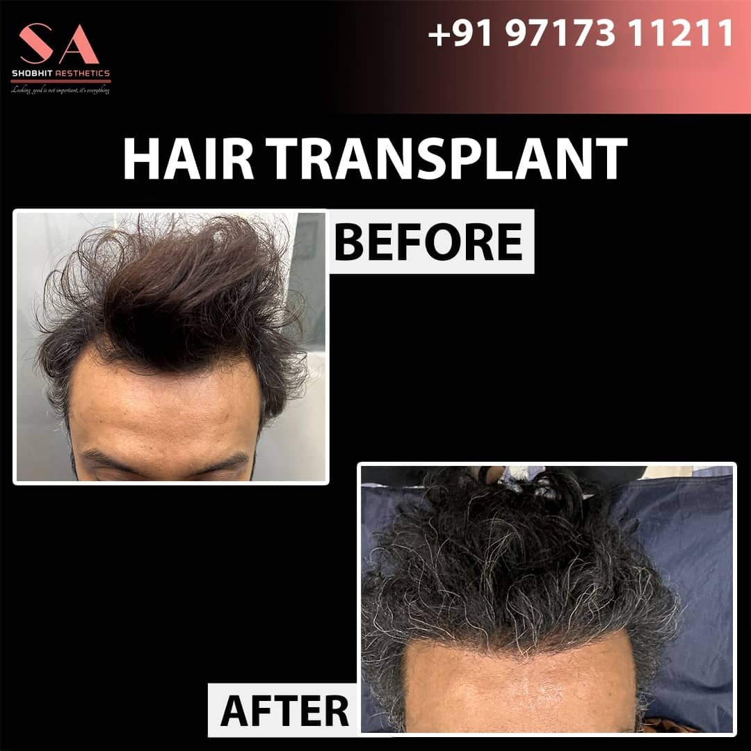 Hair Transplant 