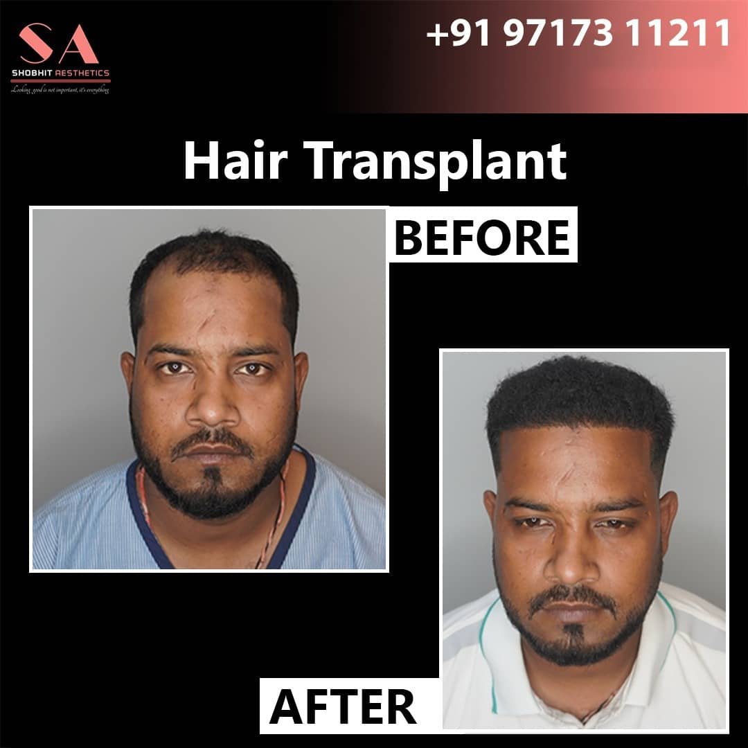 Hair Transplant in Pune