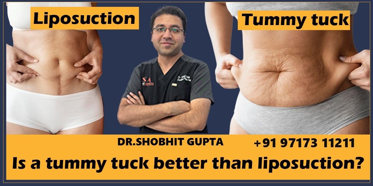 Is a Tummy Tuck Better than Liposuction?