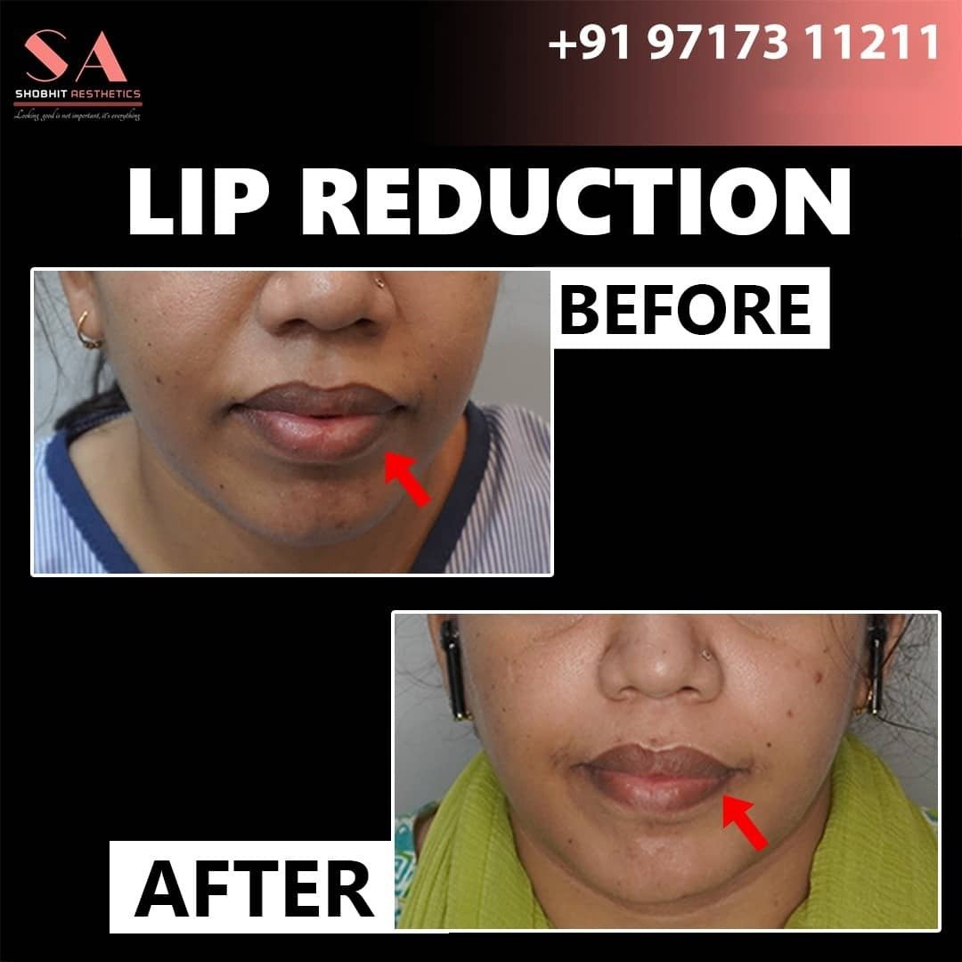 Lip Reduction