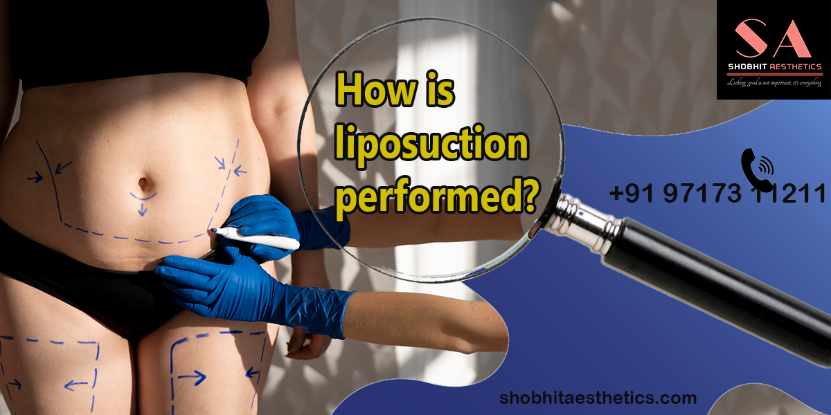 How is Liposuction Surgery Performed?