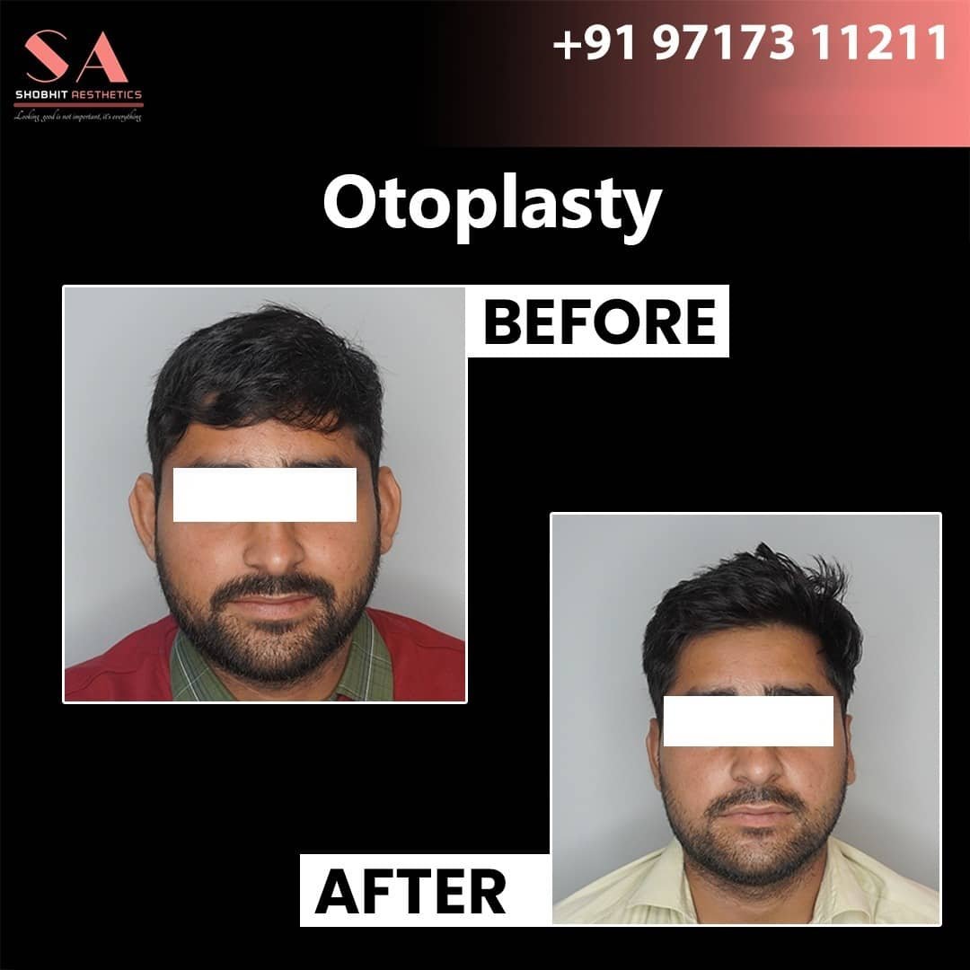 Ear Surgeries