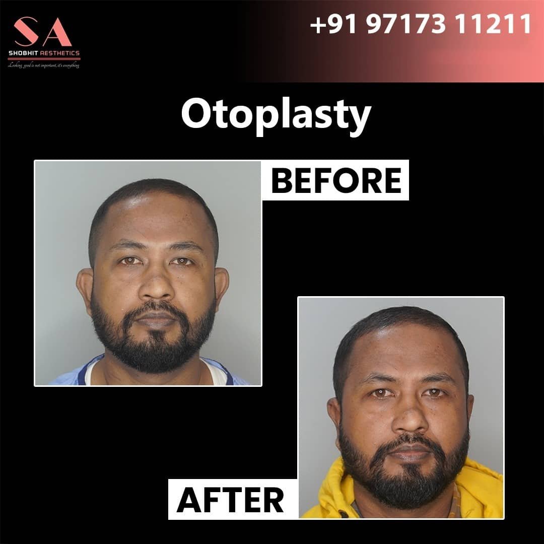 Ear Surgeries