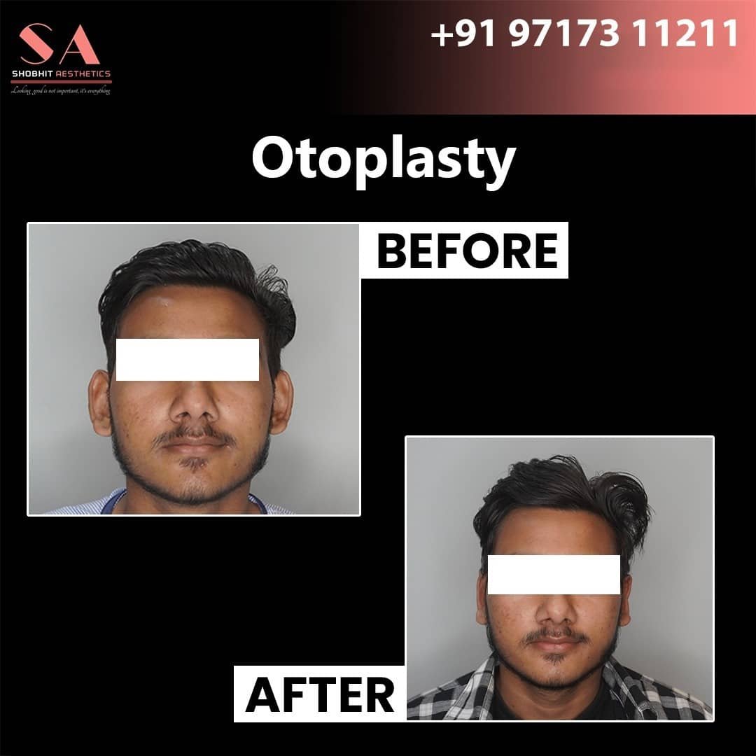 Ear Surgeries