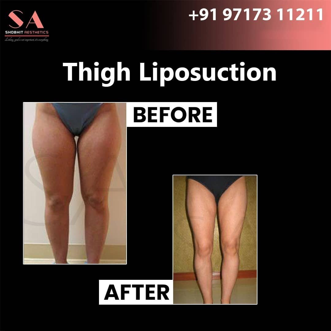 Liposuction in Noida