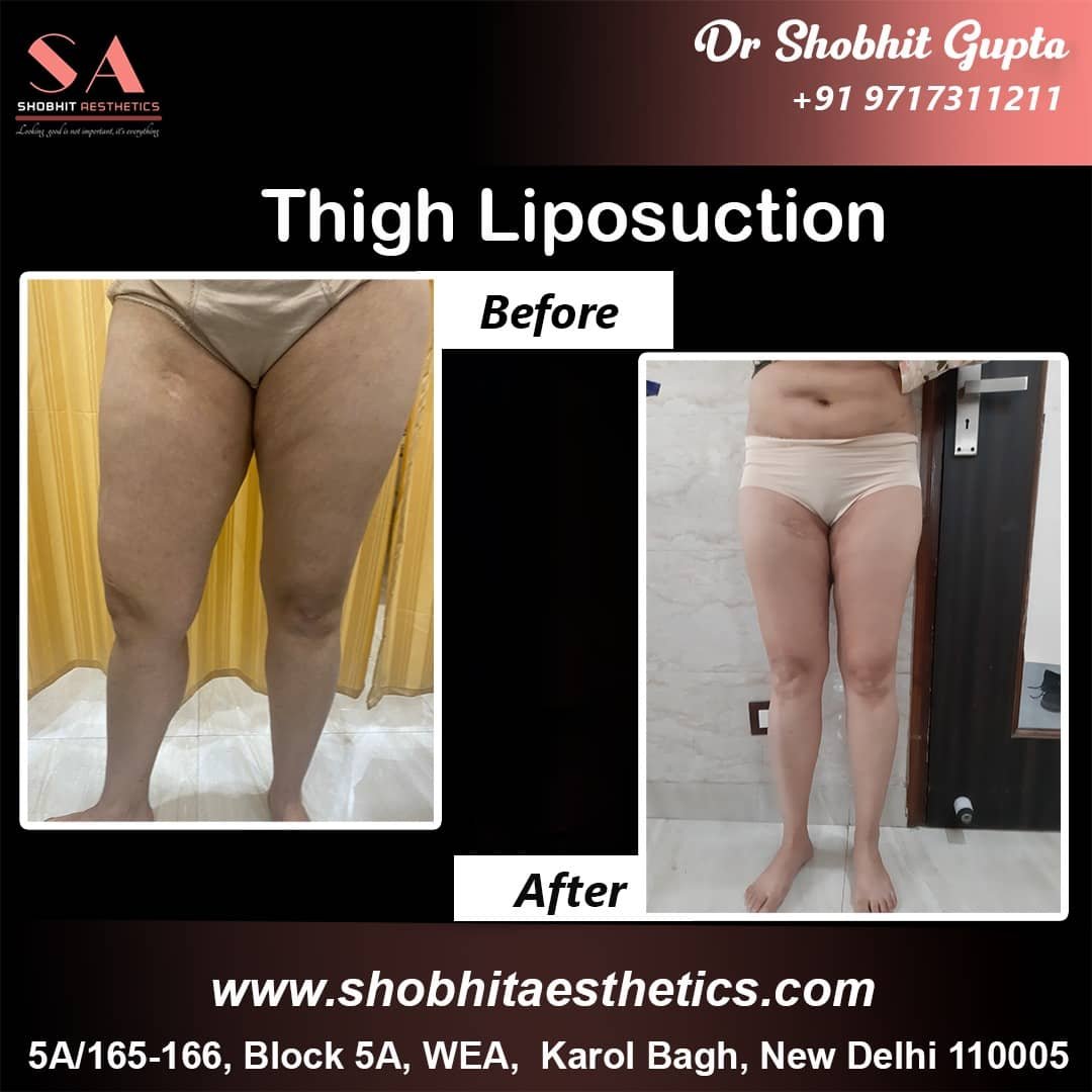 Liposuction in Noida