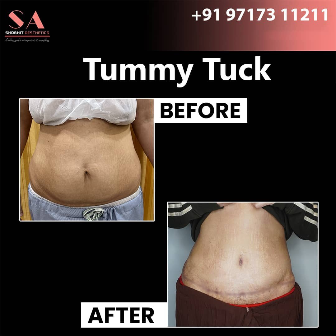 Tummy Tuck in Jaipur