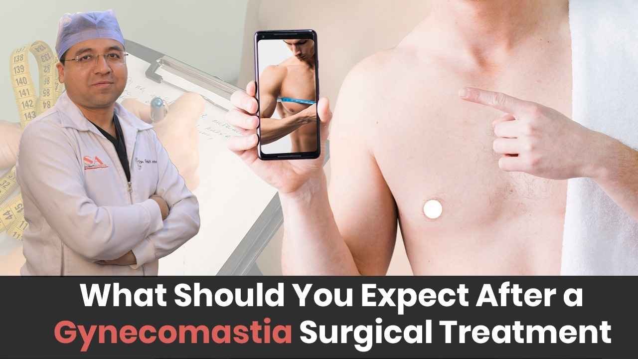 What Should You Expect After a Gynecomastia Surgical Treatment