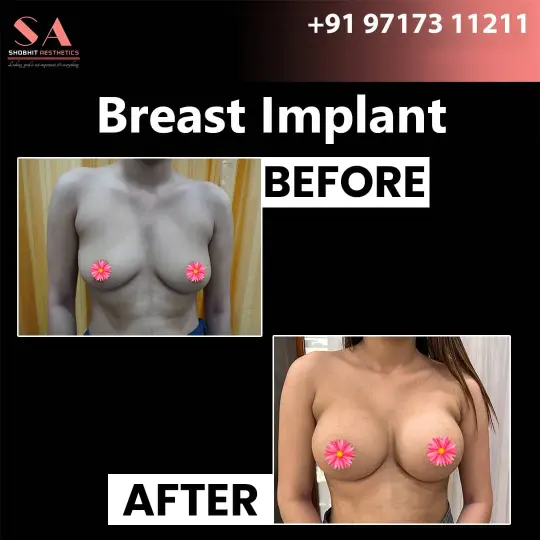 Breast Implant in Panipat