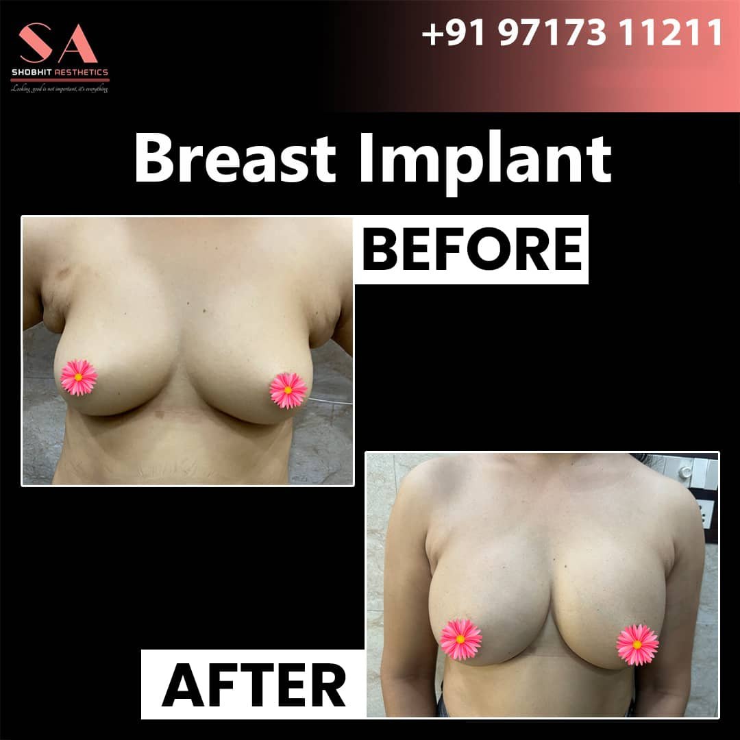 Breast Implant in Pune