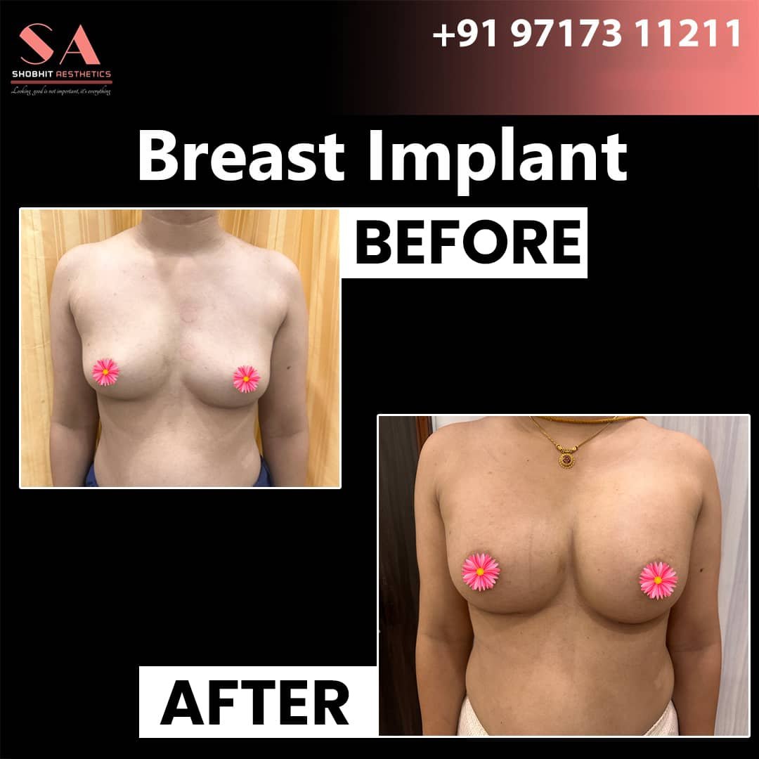 Breast Implant in Pune