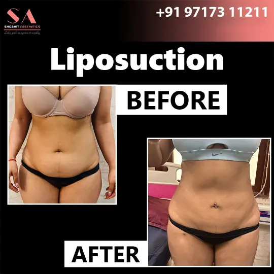 Liposuction in Noida