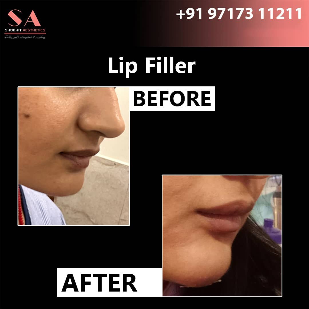 Lip Fillers