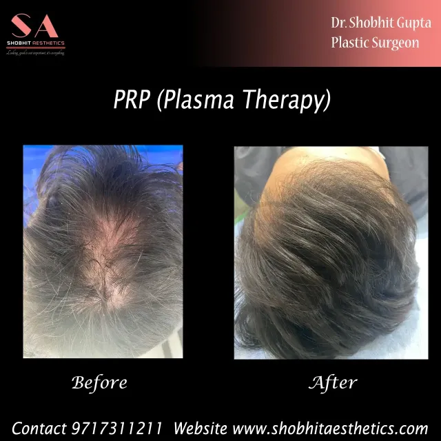 PRP & Mesotherapy