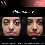 Rhinoplasty