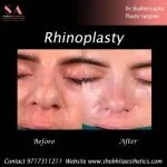 Rhinoplasty