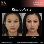 Rhinoplasty