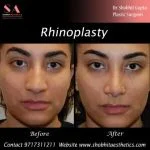 Rhinoplasty