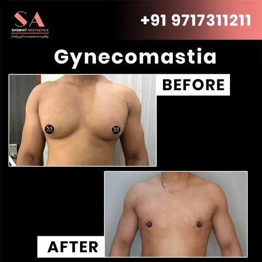 Gynecomastia in Mumbai