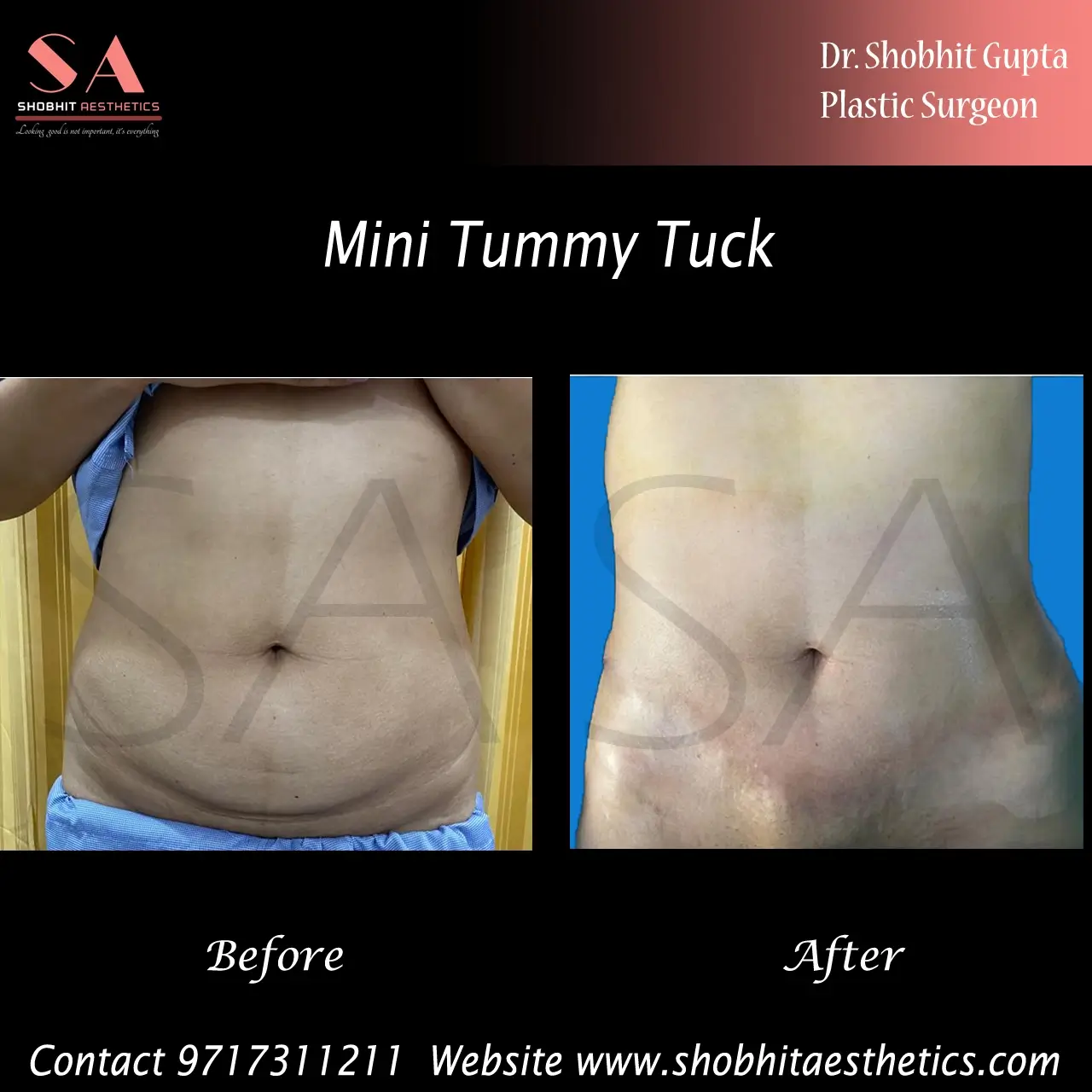 tummy-tuck-1.webp