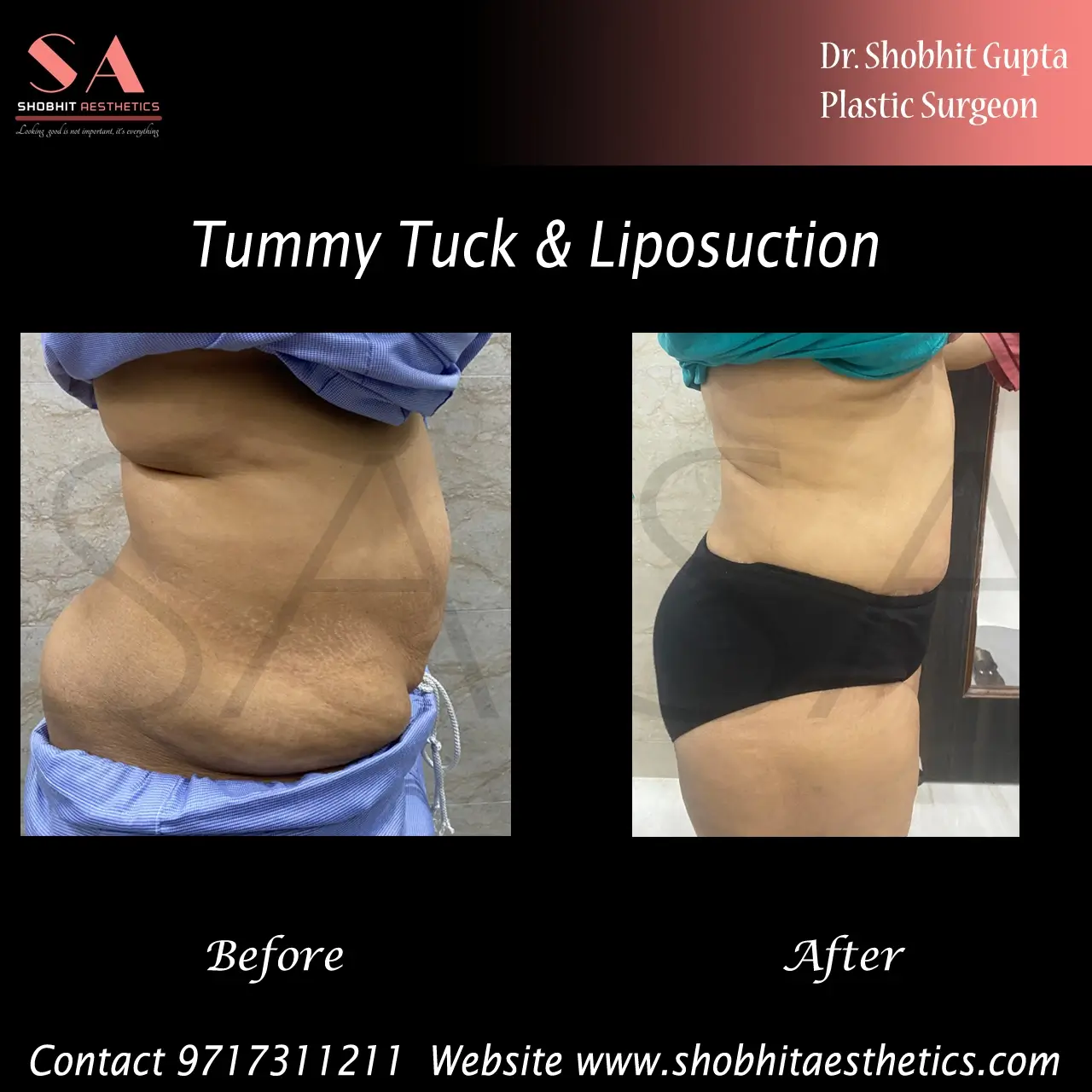 Tummy Tuck