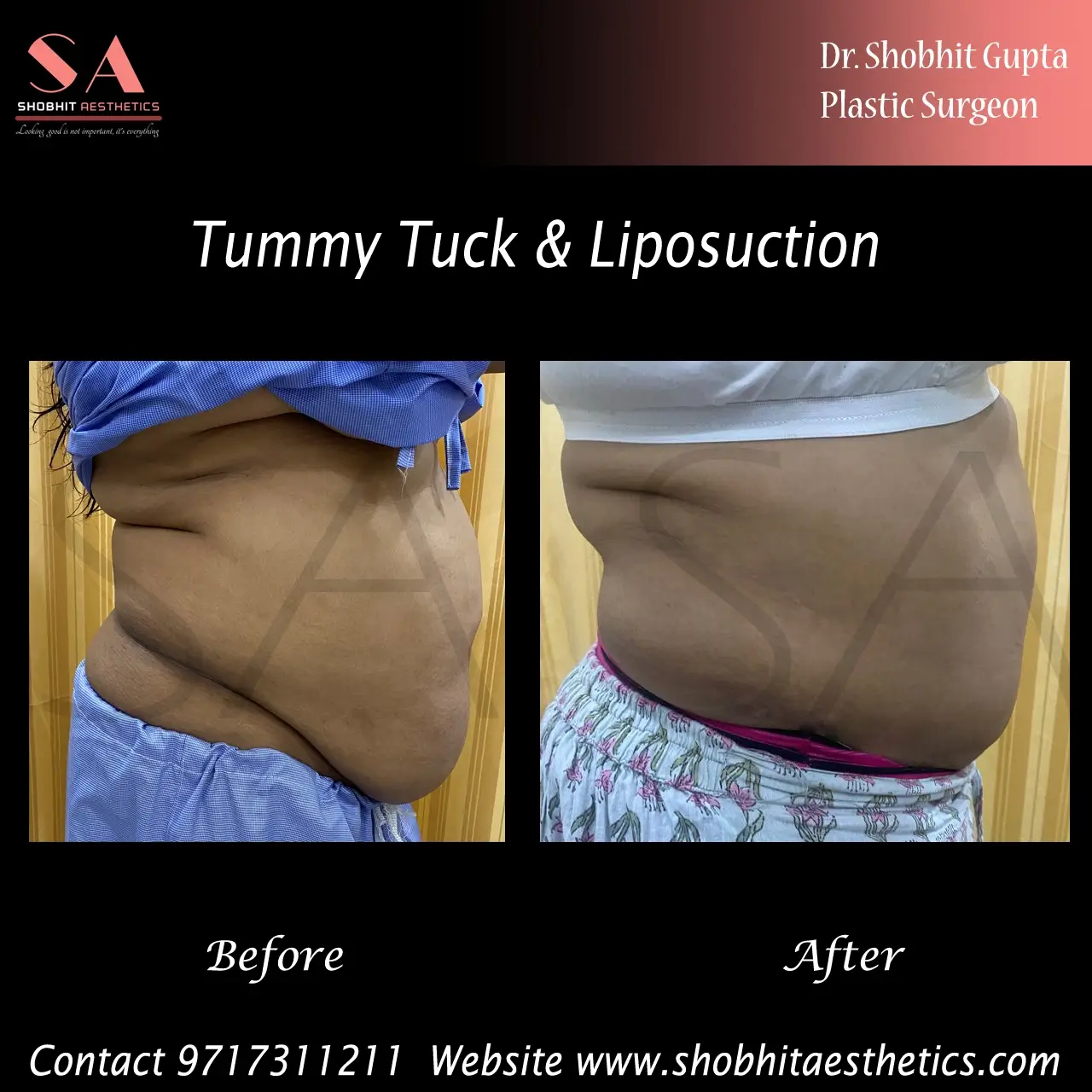 Get Tummy Tuck Surgery Cost in Delhi  Tummy Tuck Near Me - Dr. Shobhit  Gupta