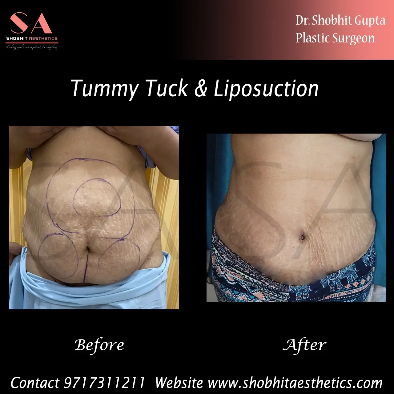 tummy-tuck-4.webp